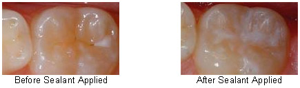 Tooth Sealants