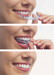 Aligner Treatment (Invisalign)