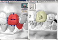 Digital Placement of Braces Decreases Treatment Time (OrthoCAD IQ)